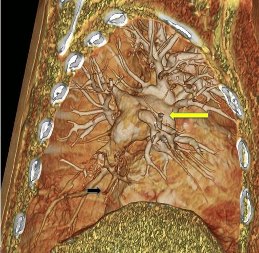 CT Angiogram CTEPH