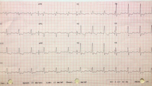 EKG to Diagnose Pulmonary Hypertension