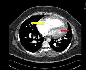 CT Angiogram severe pulmonary hypertension