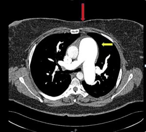CT scan severe idiopathic PAH