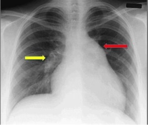 pulmonary artery hypertension