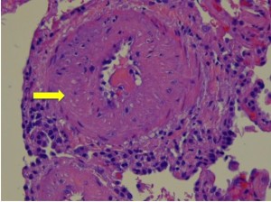 lung biopsy from patient with severe pulmonary hypertension