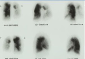 perfusion scan svår pulmonell hypertension CTEPH