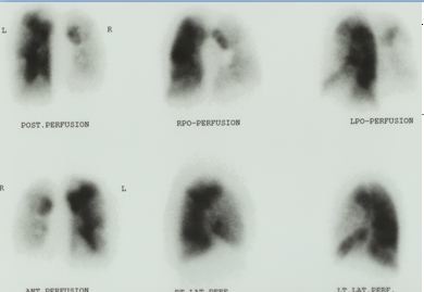 VQ perfusion lung scan severe pulmonary hypertension CTEPH