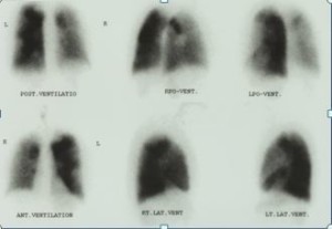 ventilationsskanning CTEPH