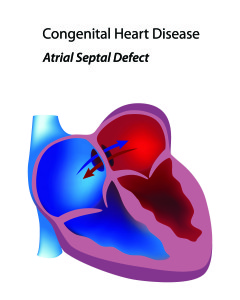 Congenital heart 