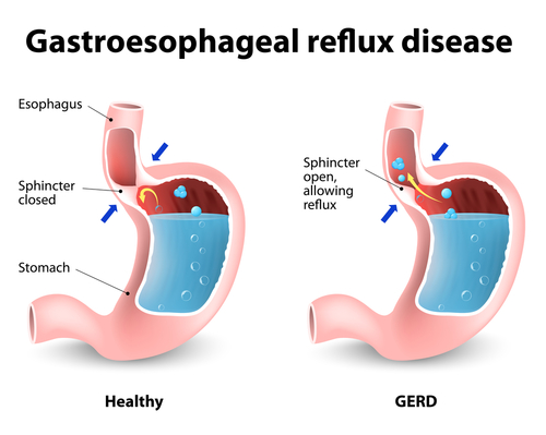 GERD with Pulmonary Hypertension