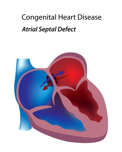 congenital heart disease atrial septal defect