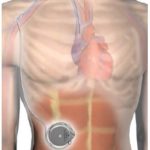 implantable remodulin pump system for pulmonary hypertension patients