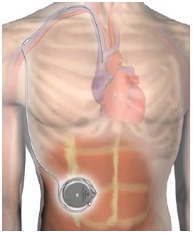 implantable remodulin pump system for pulmonary hypertension patients