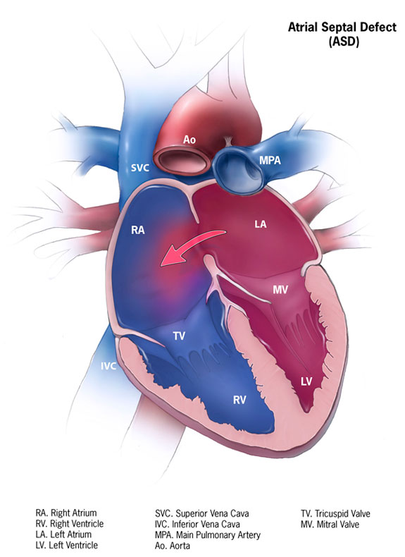 atrial-septal-defect-asd-and-pulmonary-arterial-hypertension